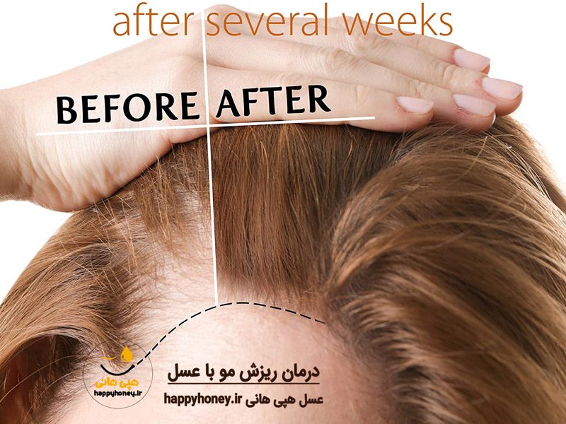 درمان ریزش مو با عسل