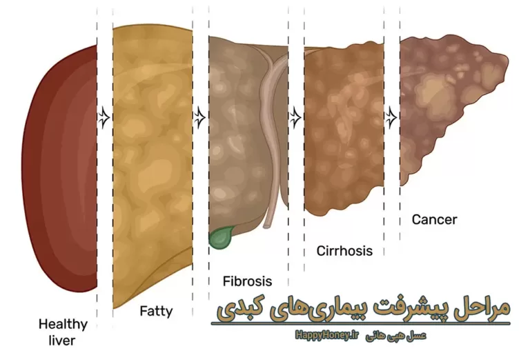 fatty liver مراحل پیشرفت بیماری کبدی