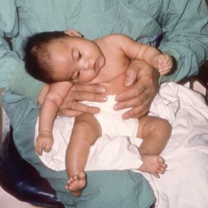 بوتولیسم نوزاد