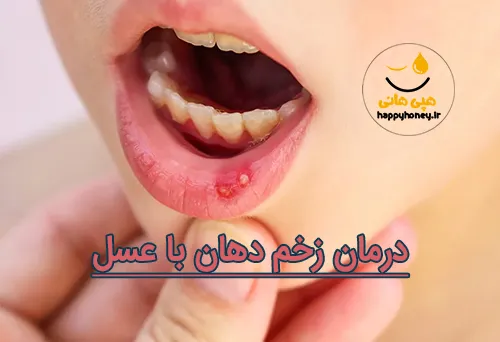 رفع زخم دهان کودک با عسل