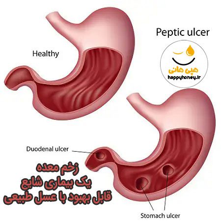 درمان خانگی زخم معده