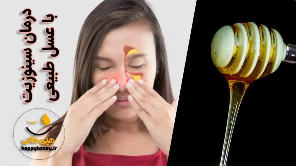 درمان سینوزیت با عسل طبیعی